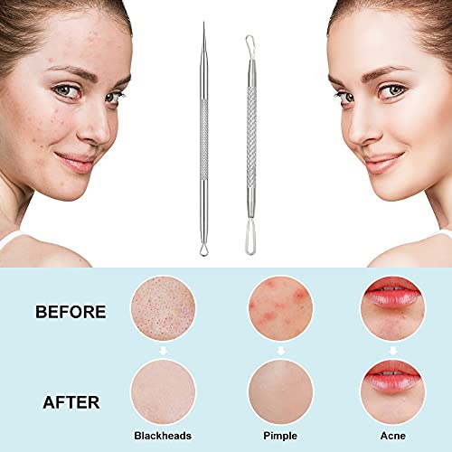 Blackhead Remover, 2 PCS Pimple Popper ，Stainless Steel Pimple Extractor Blackhead Removal Tool Risk Free Treatment for Blemish,Whitehead Popping - Morena Vogue