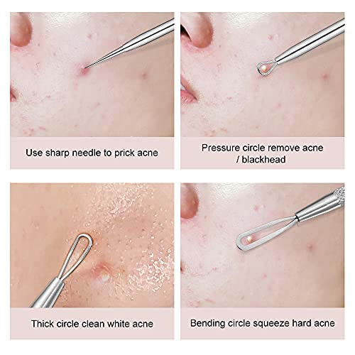 Blackhead Remover, 2 PCS Pimple Popper ，Stainless Steel Pimple Extractor Blackhead Removal Tool Risk Free Treatment for Blemish,Whitehead Popping - Morena Vogue