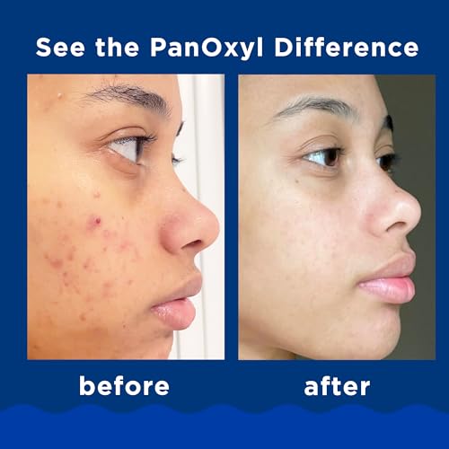 PanOxyl Acne Foaming Wash Benzoyl Peroxide 10% Maximum Strength Antimicrobial, 5.5 Oz - Morena Vogue